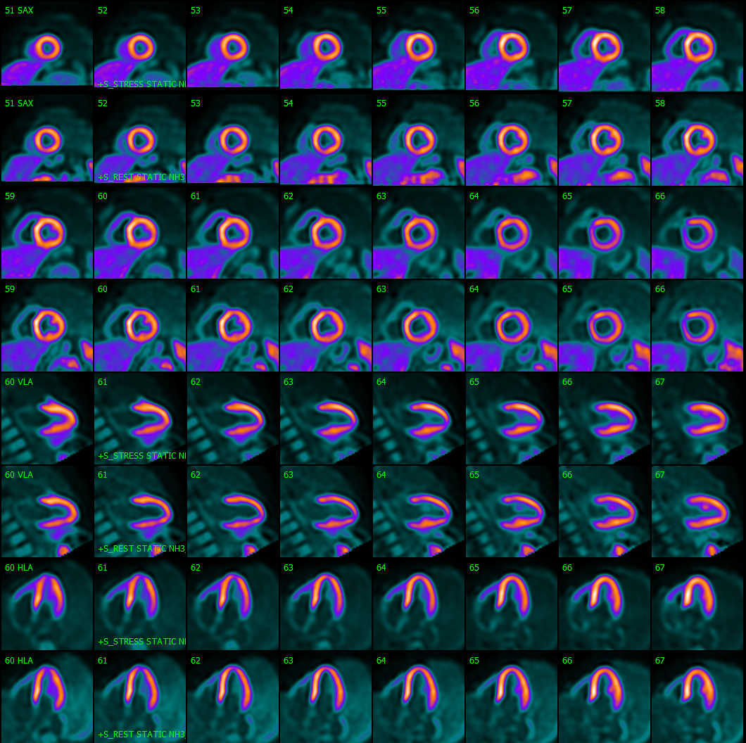 N-13 Ammonia: Advanced Cardiac PET Imaging