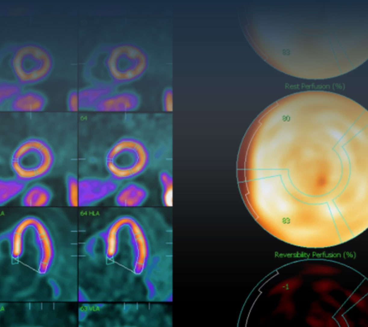 N-13 Ammonia cardiac PET imaging